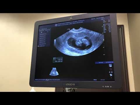 11 Week Ultrasound- Very Active Baby