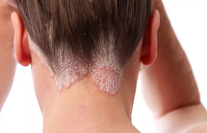 12 Home Remedies For Managing Scalp Psoriasis Effectively HD Wallpaper