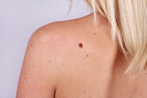 12 Natural Ways To Get Rid Of Moles, Skin Tags And More HD Wallpaper