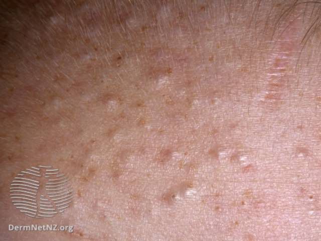 20 Types Of Skin Lesions And What They Look Like
