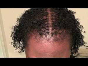 23 month Sisterlocks© Hair Growth Timelapse on Fine Thin Hair Low Density Crown HD Wallpaper
