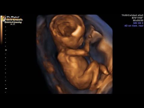 4D Ultrasound Fetus 16 Weeks Jumping  Rafael Ortega Muñoz Md Gynecologist Ciudad