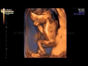 4D ultrasound pregnancy  15 weeks fetus jumping  Rafael Ortega Muñoz MD Gynecolo HD Wallpaper