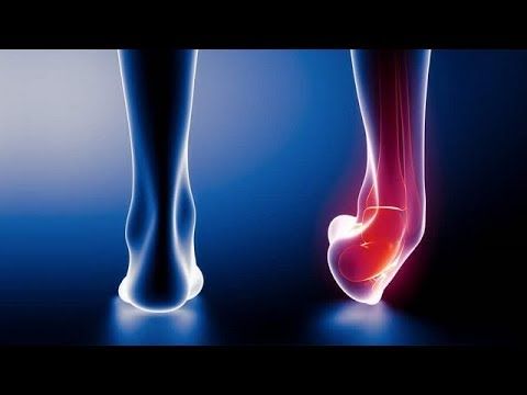 5 Best Ways To Treat A Sprained Ankle By