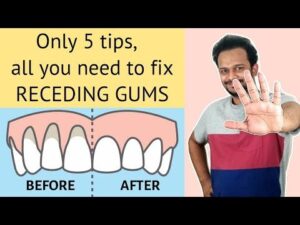5 Habits to Naturally Heal Sensitive Teeth, Reverse Receding Gums, Gingivitis ,  Images
