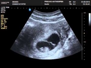 8 Weeks Pregnant 2D Ultrasound: Heartbeat HD Wallpaper