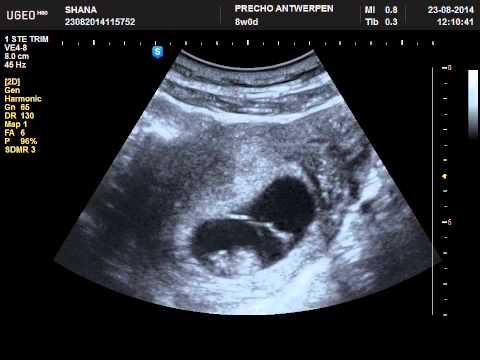 8 Weeks Pregnant 2D Ultrasound: Heartbeat