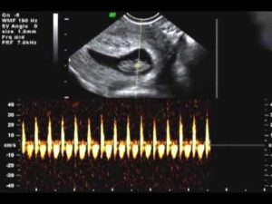 8 weeks 2 days Ultrasound Heartbeat HD Wallpaper