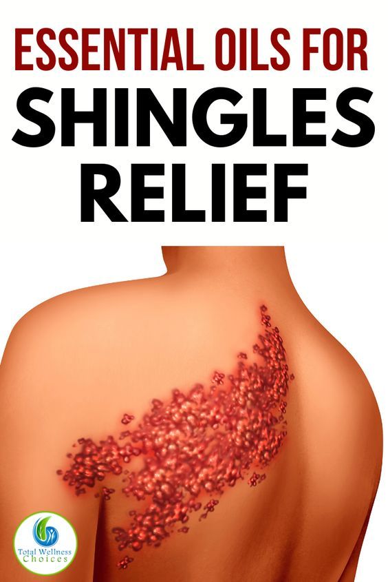 9 Best Essential Oils For Shingles Pain