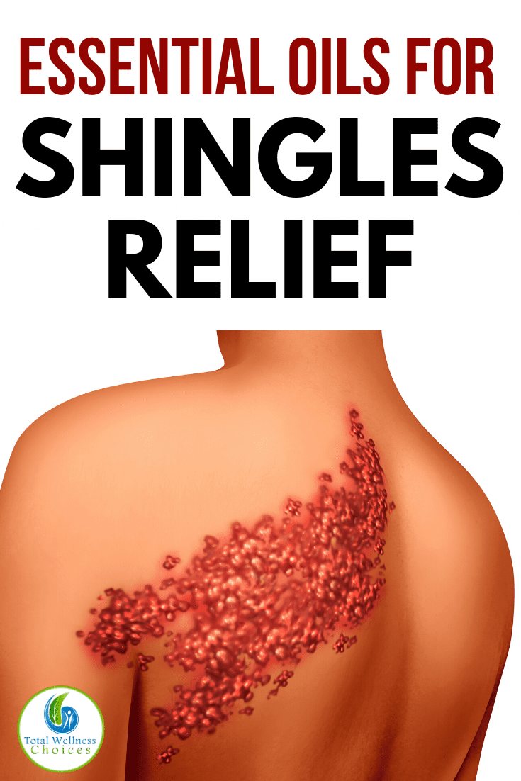 9 essential Oils for Shingles Relief