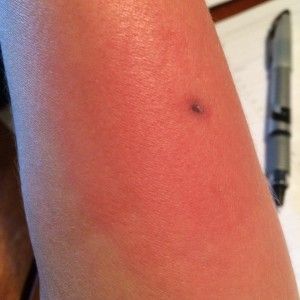 A Brown Recluse Bite