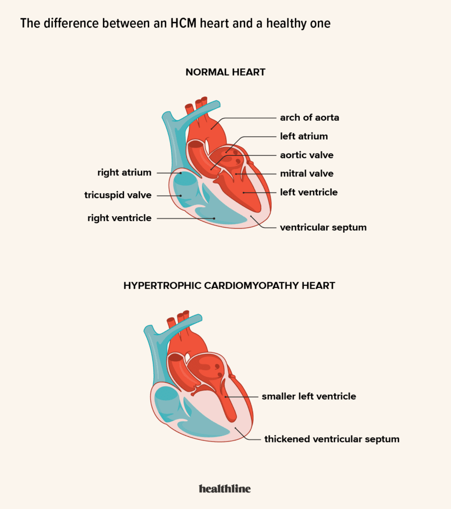 A Guide To Understanding Hypertrophic Cardiomyopathy Images
