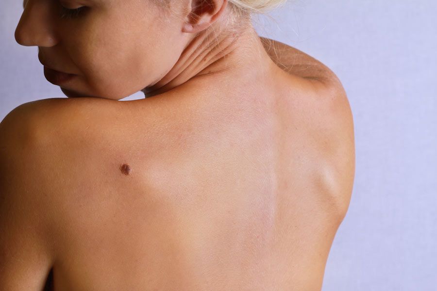 Ask The Expert Painful Moles Images