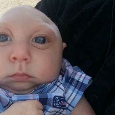 Baby Jaxon, Born Without Skull, Says 'I Love You,' Passes Expectations
