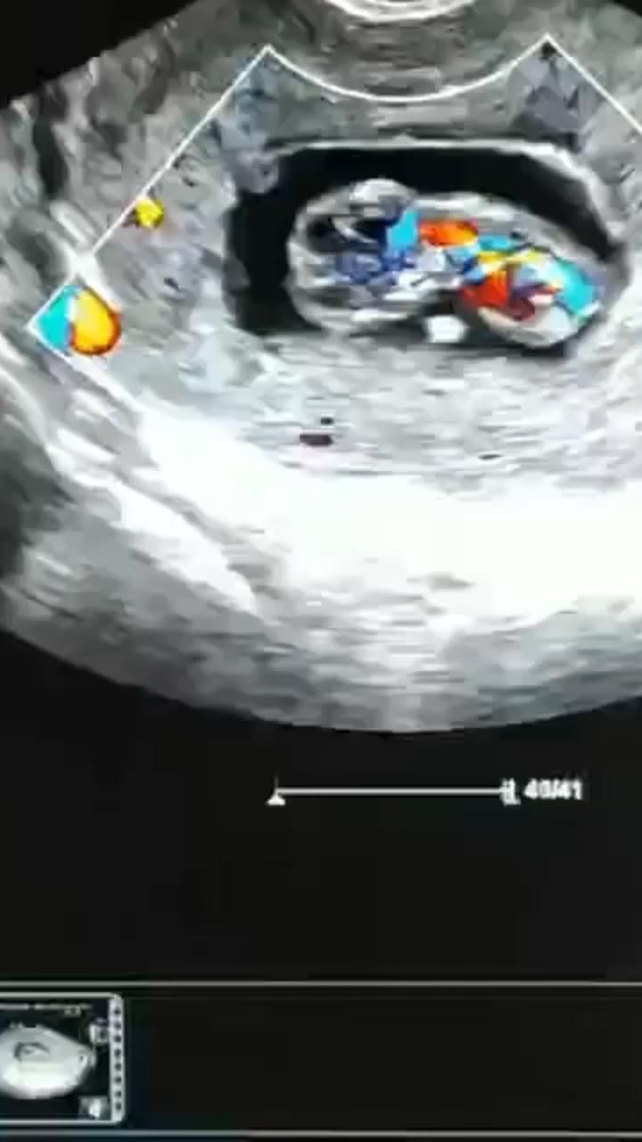 Baby ultrasound 