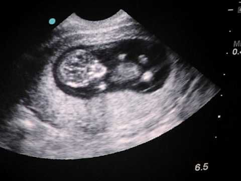 Babys First Ultrasound 11 Weeks 1 Day Images