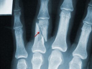 Broken Finger: Symptoms, X,Rays, Tips, Treatment, Surgery , HD Wallpaper