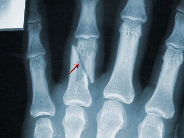 Broken Finger: Symptoms, X-Rays, Tips, Treatment, Surgery &Amp; Pictures