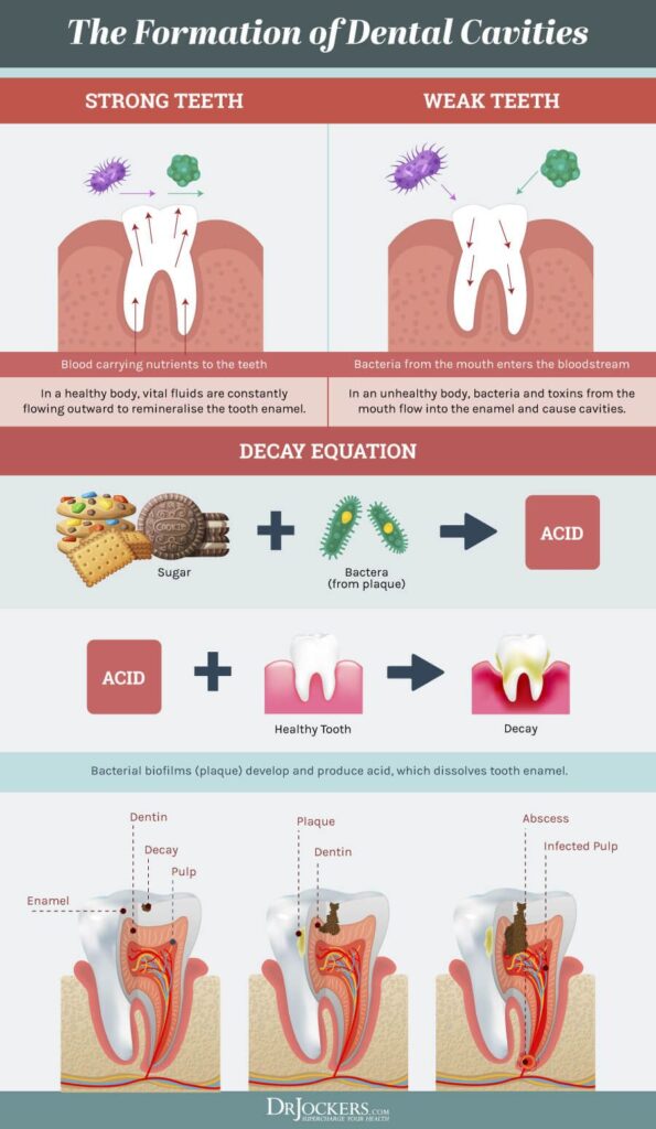 Cavities Symptoms Causes And Support Strategies Images