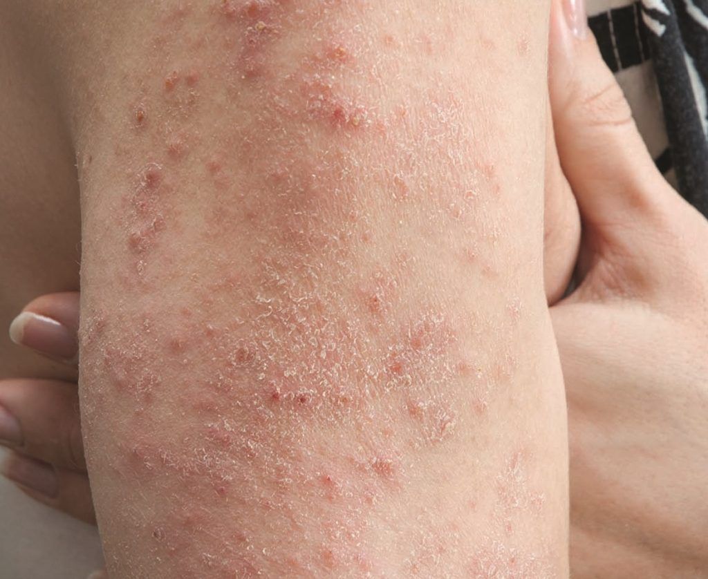Celiac That'S Skin Deep: The Mysterious Rash Sparked By Gluten
