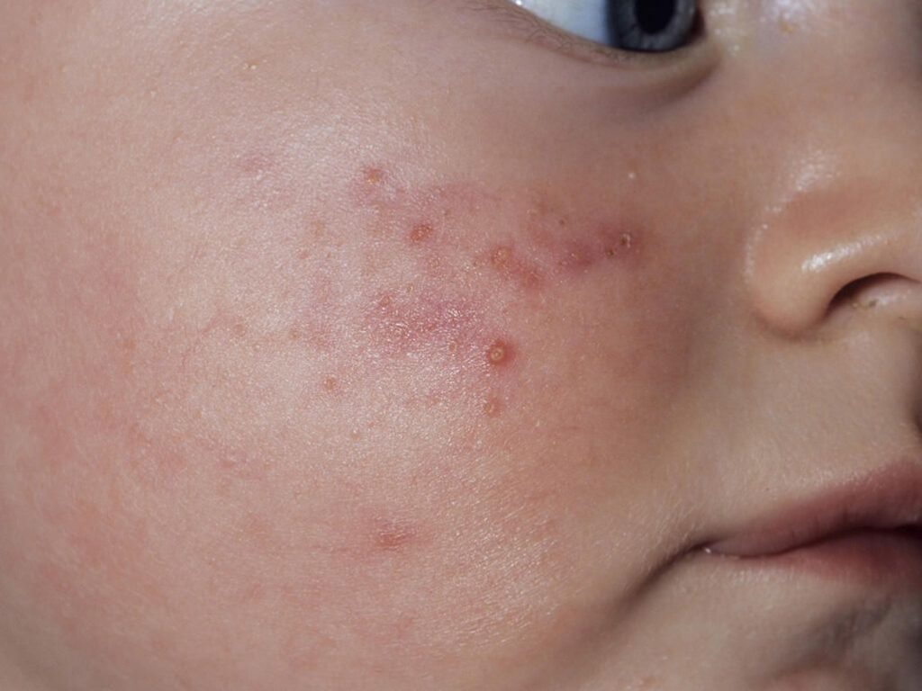 Childhood Rashes, Skin Conditions And Infections: Photos