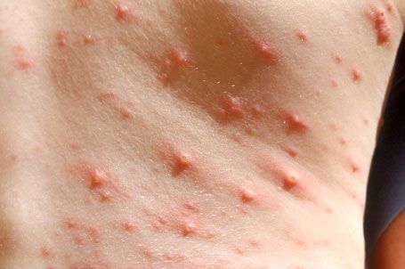 Childhood rashes, skin conditions and infections: photos