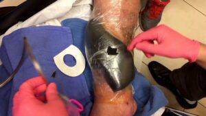 Correct wound VAC technique,, @DrArthurMiami ,, negative Pressure wound therapy  Images