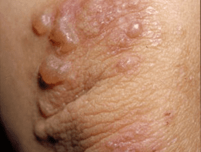 Dermatitis Herpetiformis: Features, Diagnosis, And Treatment
