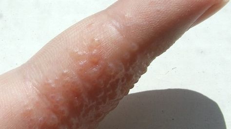Dyshidrotic Eczema (Dyshidrosis): Causes, Pictures, and More