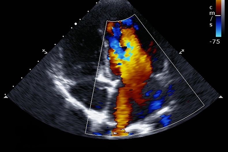 Echocardiogram: What You Need To Know | Upmc Healthbeat