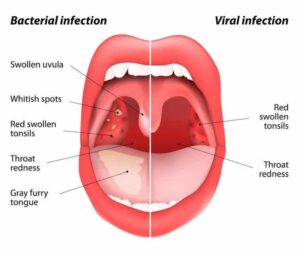 Essential Oils For Strep Throat: When You Wish You Could Say Streptococcal Phary HD Wallpaper