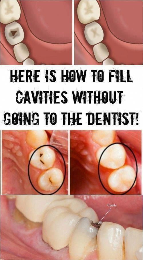 Fill Cavities Without Going to the Dentist with this Method