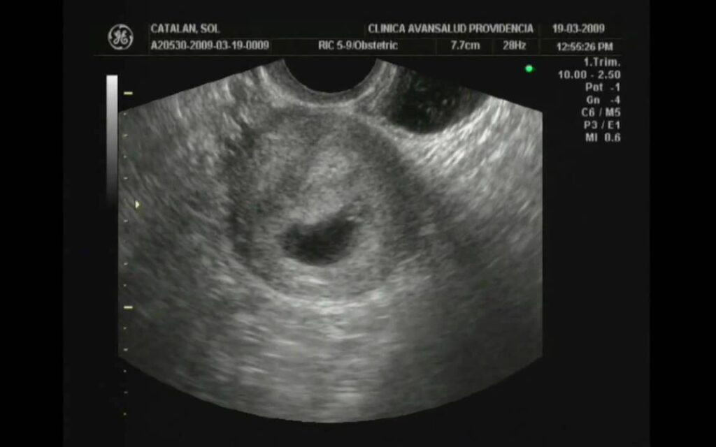 First Ultrasound 4-6 Weeks. Primer Ultrasonido 4-6 Semanas