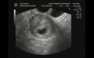 First Ultrasound 4,6 weeks. Primer Ultrasonido 4,6 semanas HD Wallpaper