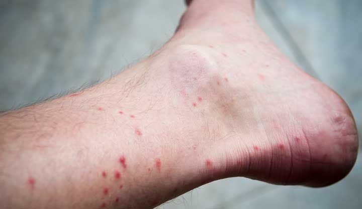 Flea Bites: What They Look Like, Symptoms &Amp; Treatment
