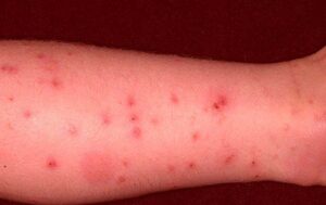 Flea Bites on Humans: Symptoms, Treatment, HD Wallpaper