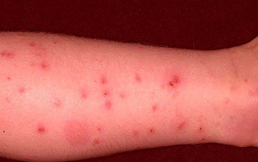 Flea Bites On Humans: Symptoms, Treatment, Pictures