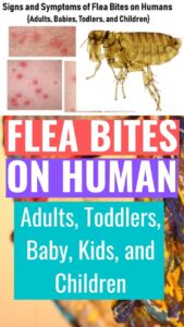 Flea Bites on Humans: What Do Fleabites Symptoms Really Look LikeHD Wallpaper