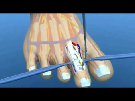 Hammer Toe Surgery Explained Podiatry Claw Toe Mallet Toe