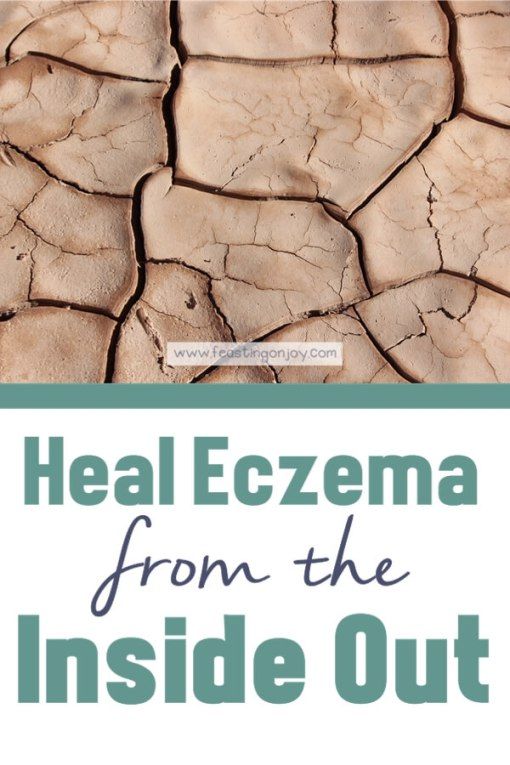 Heal Your Eczema from the Inside Out | Feasting On Joy