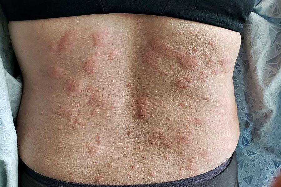 Home Remedies for Hives: What Really Helps?