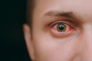 Home Remedies for Pink Eye: 8 Natural Remedies for Pink Eye that WorkHD Wallpaper