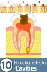 How To Get Rid Of Cavities , 7 Home Remedies To Follow HD Wallpaper