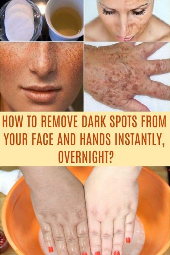 How To Get Rid of Pigmentation And Dark Spots Naturally
