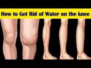 How to Get Rid of Water on the Knee || 6 Home Remedies for Water on the Knee Sym HD Wallpaper