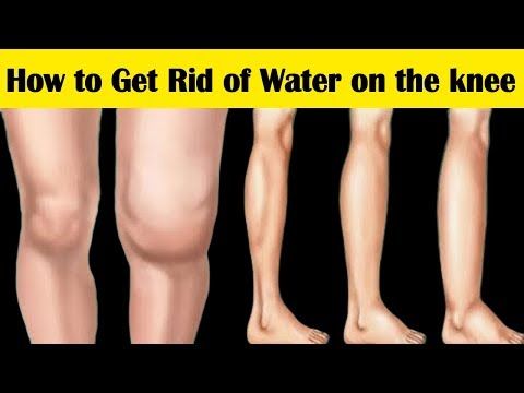 How to Get Rid of Water on the Knee || 6 Home Remedies for Water on the Knee Sym