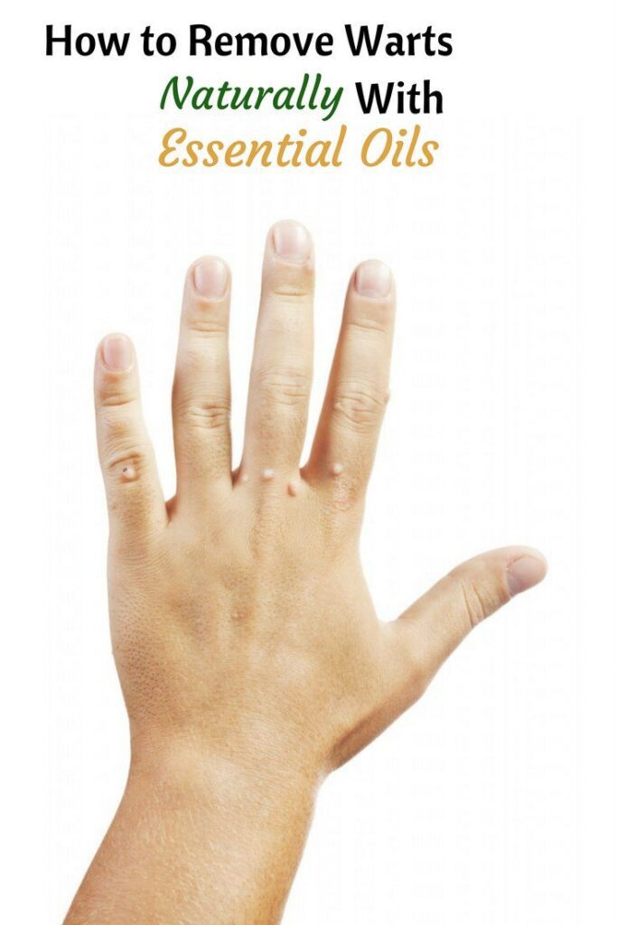 How To Remove Warts Naturally With Essential Oils Organic