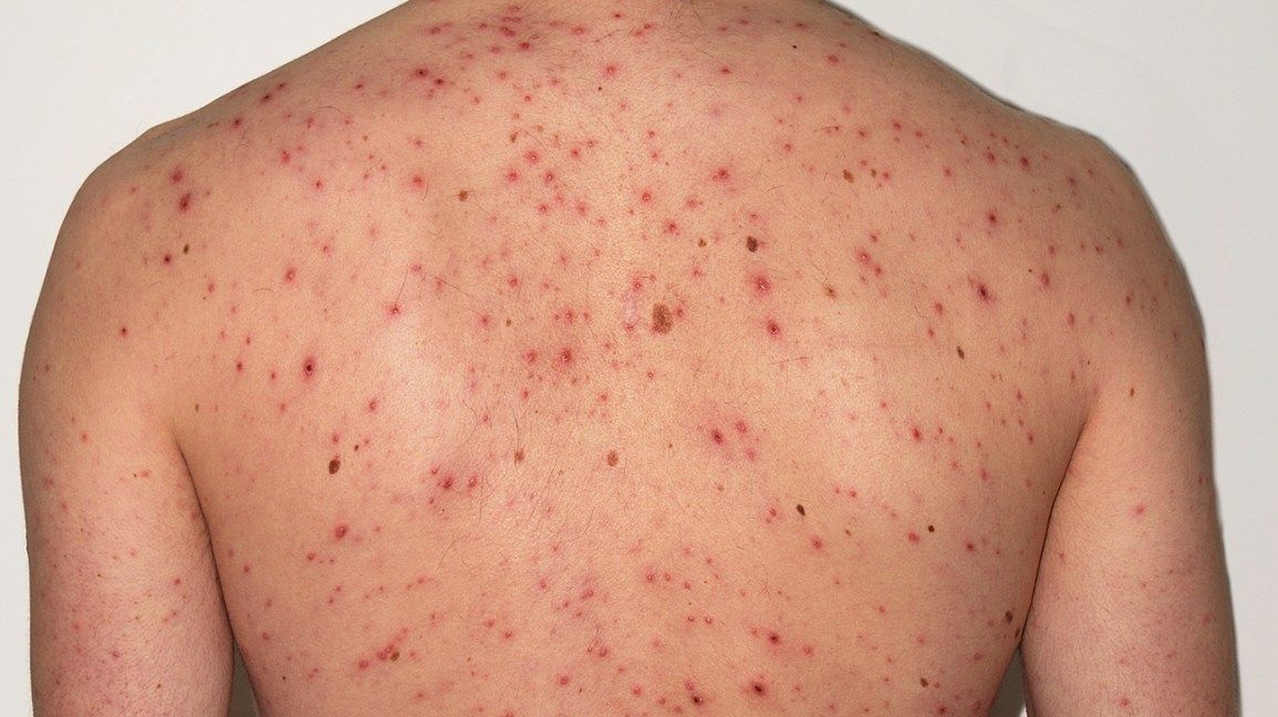 Internal shingles: What to know about shingles without a rash