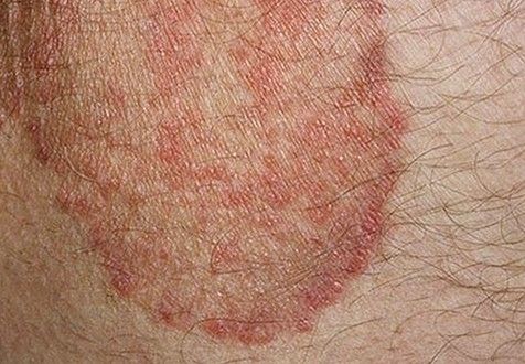 Itchy Skin Rash Causes Symptoms Treatment Images