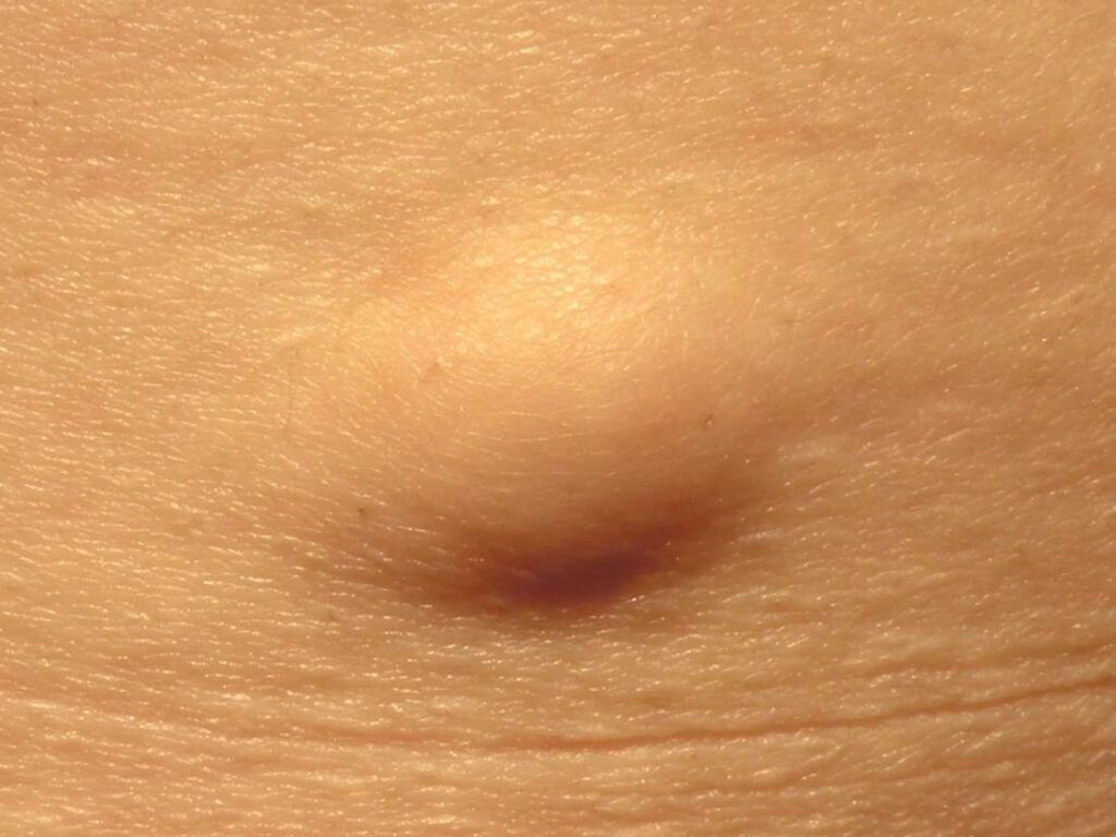 Lipoma Causes Symptoms Diagnosis And Removal Images